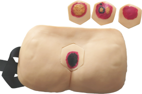 Advanced Pressure Ulcer ( Pressure Sore ) Nursing Model product image 1