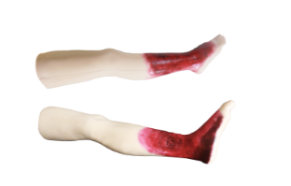 Advanced Chronic Leg Ulcer Diagnosis Training Model product image 1